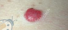 angioma