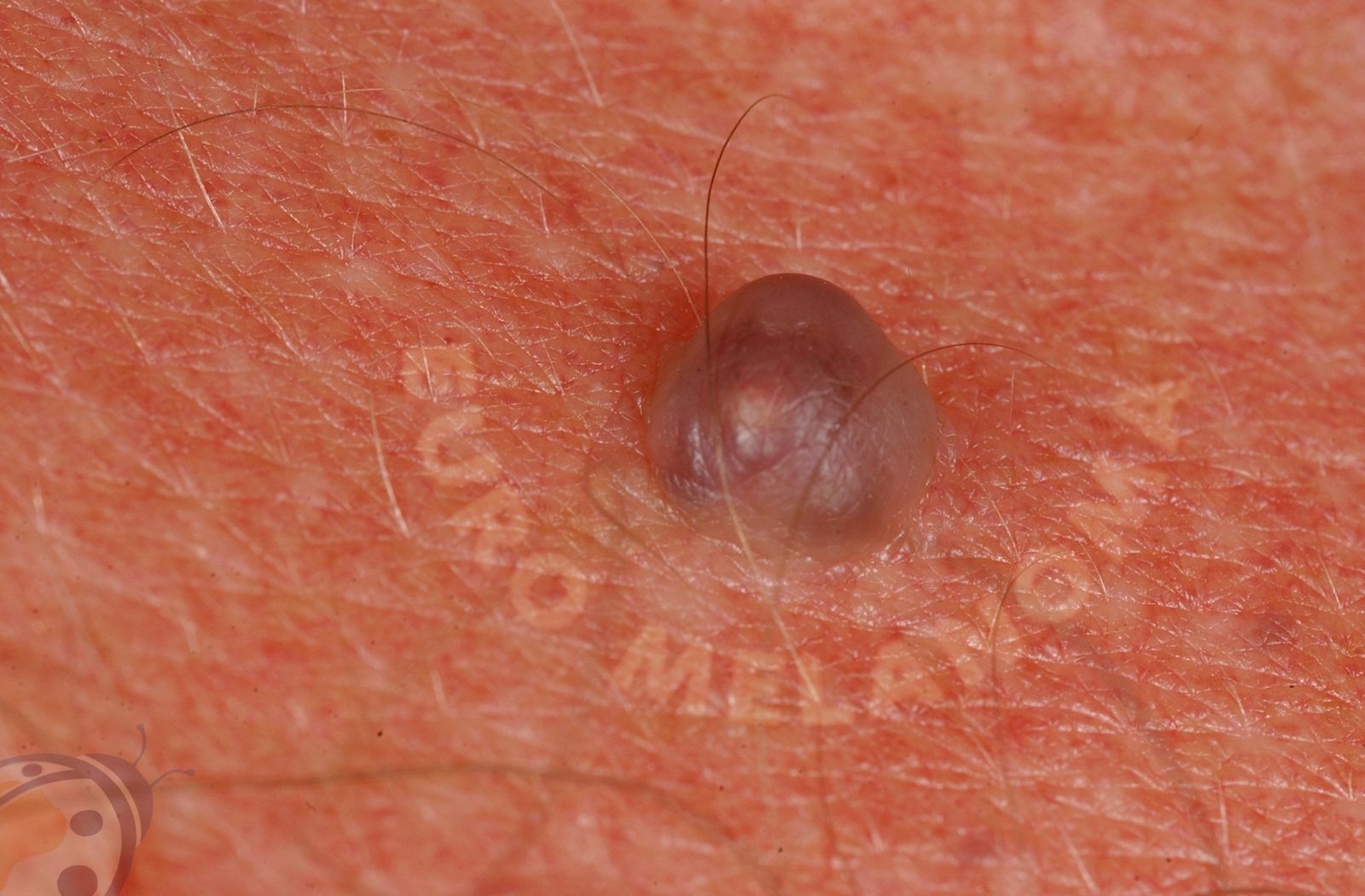 hemangioma