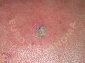 actinic keratosis