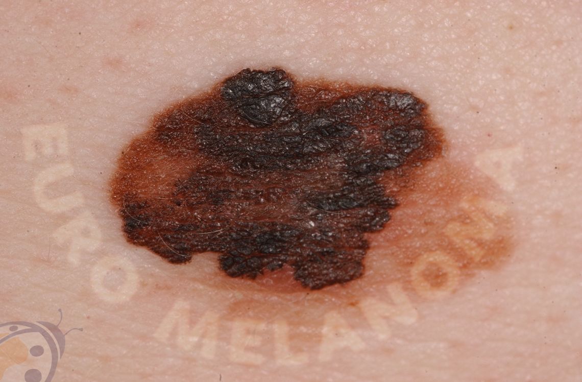 Melanoma