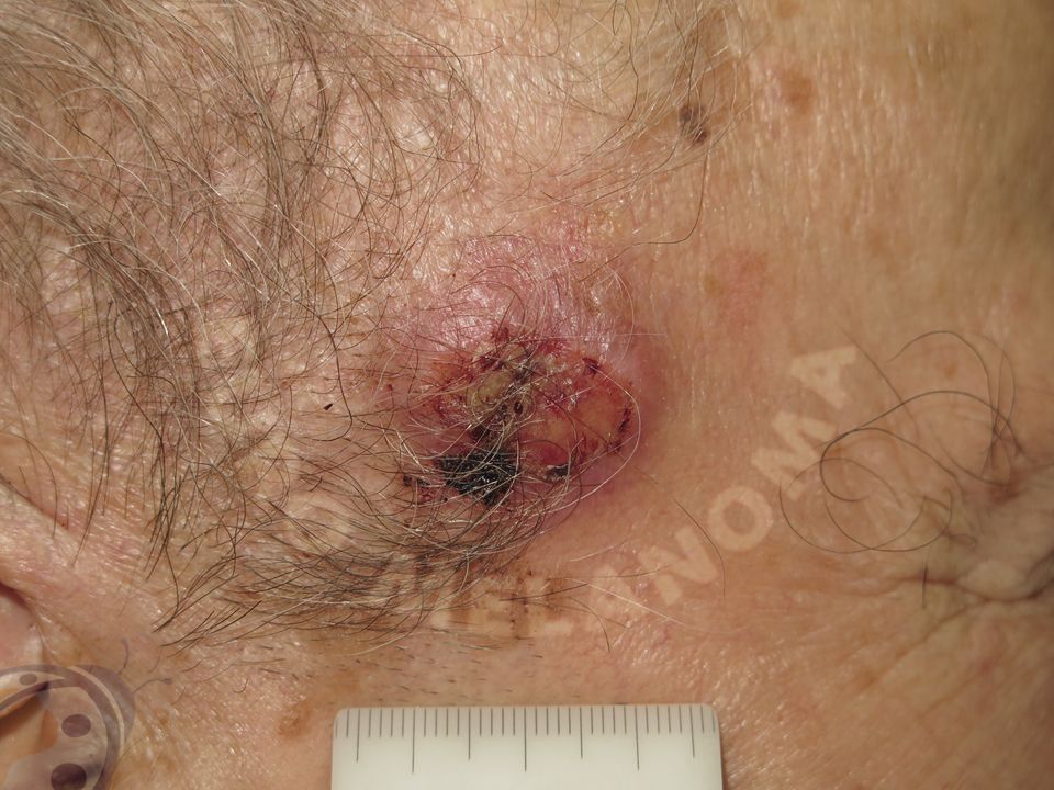 Merkel cell carcinoma